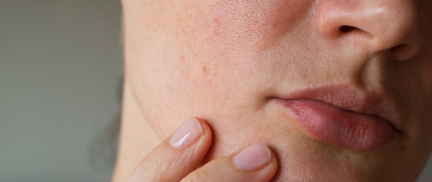 Top 10 Easy Oily Skin Care Tips for Monsoons